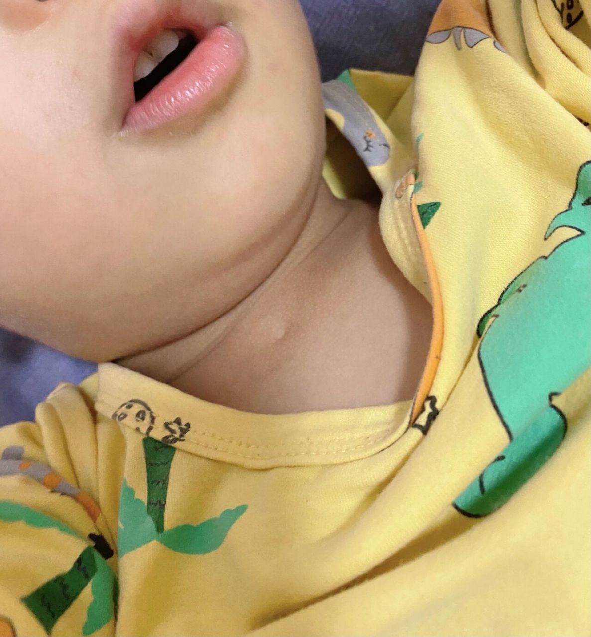 我儿子胸口有小窝 我家小朋友刚出生胸口就有个小窝