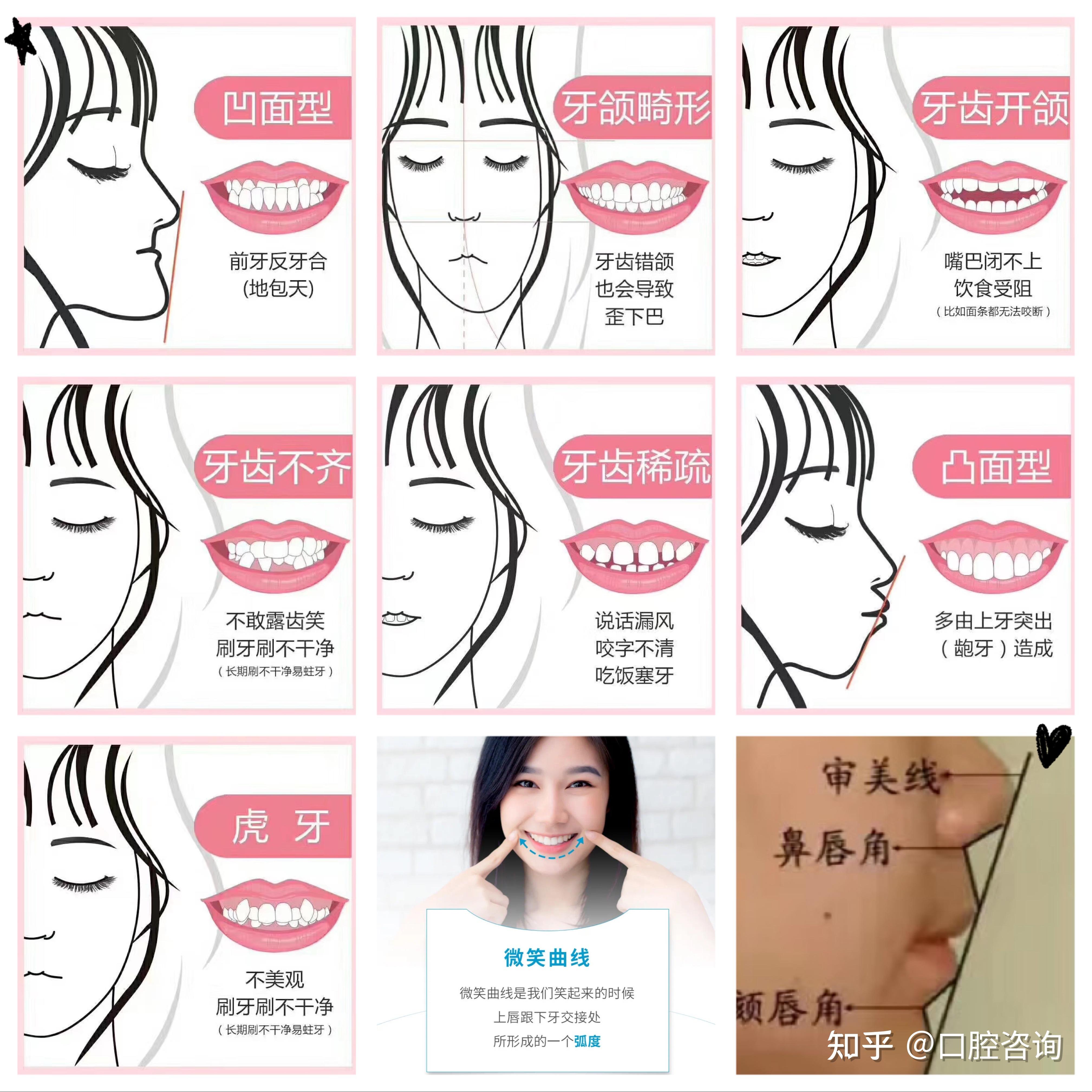 深覆合正畸是怎样一种体验