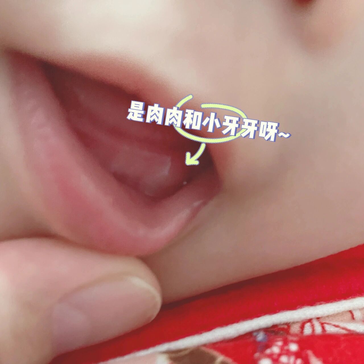 宝宝长牙牙龈鼓包红肿图片