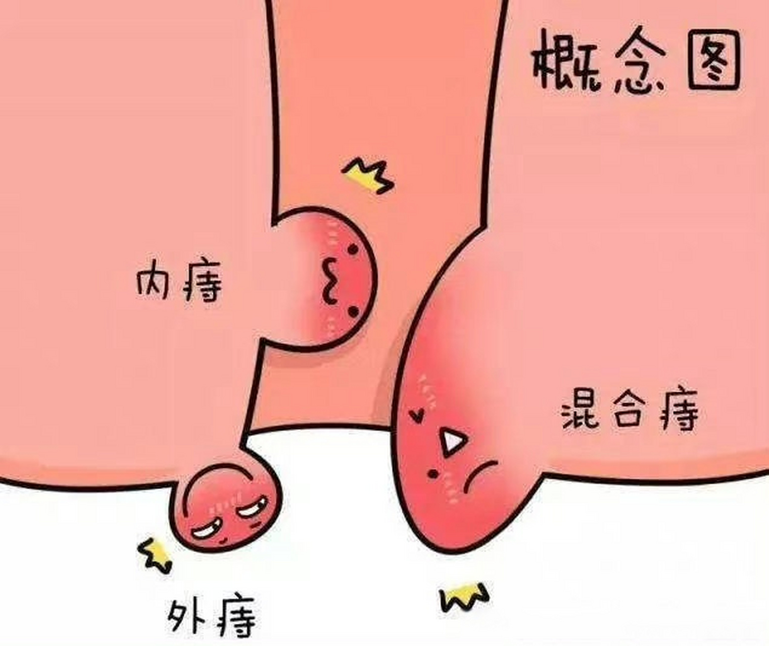 北京复兴路门诊中医肛肠:痔疮的形成原因,分类以及与肠癌的区分 最近