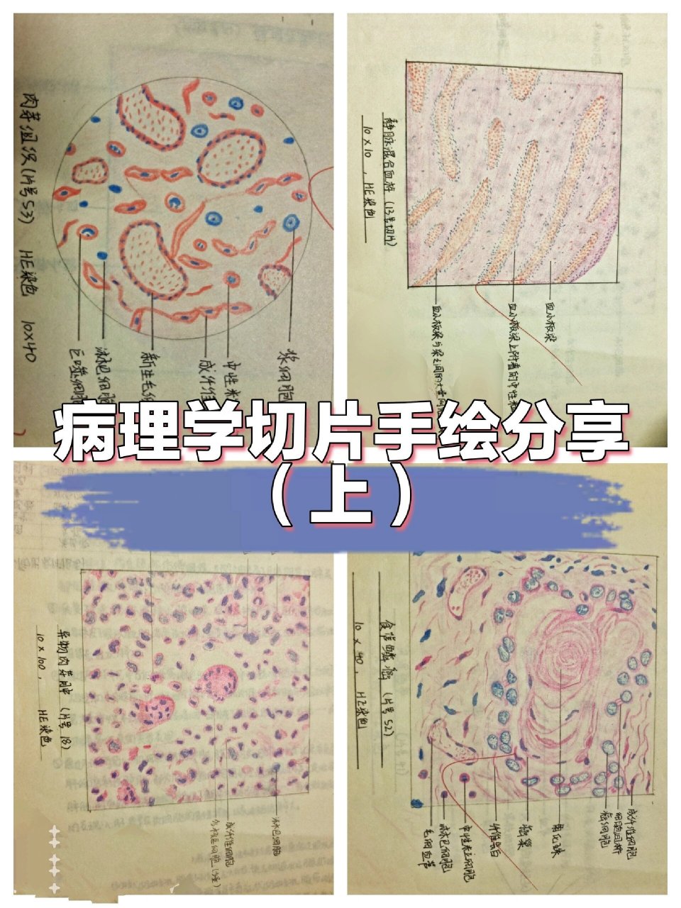 肉芽组织 2.静脉混合血栓 3.异物肉芽肿 4.