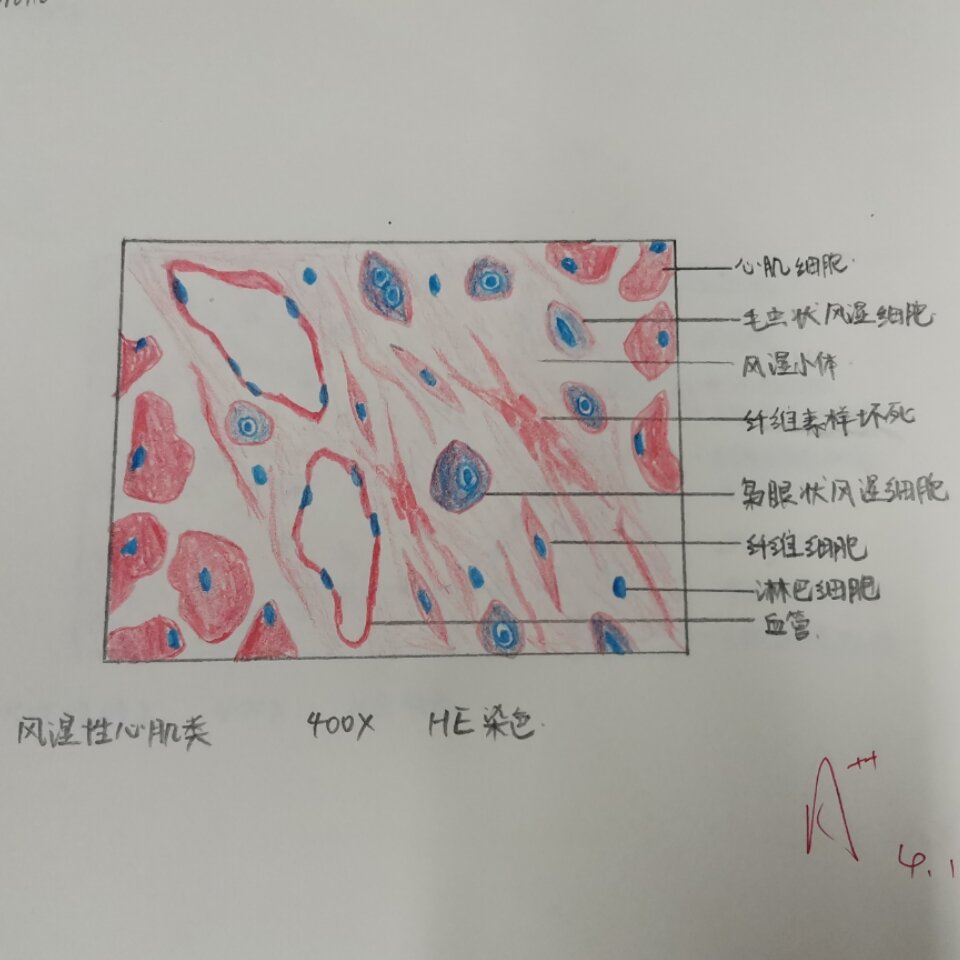 病理红蓝铅笔绘图 风湿性心肌炎 大叶性肺炎 肺气肿 慢性胃溃疡 门脉