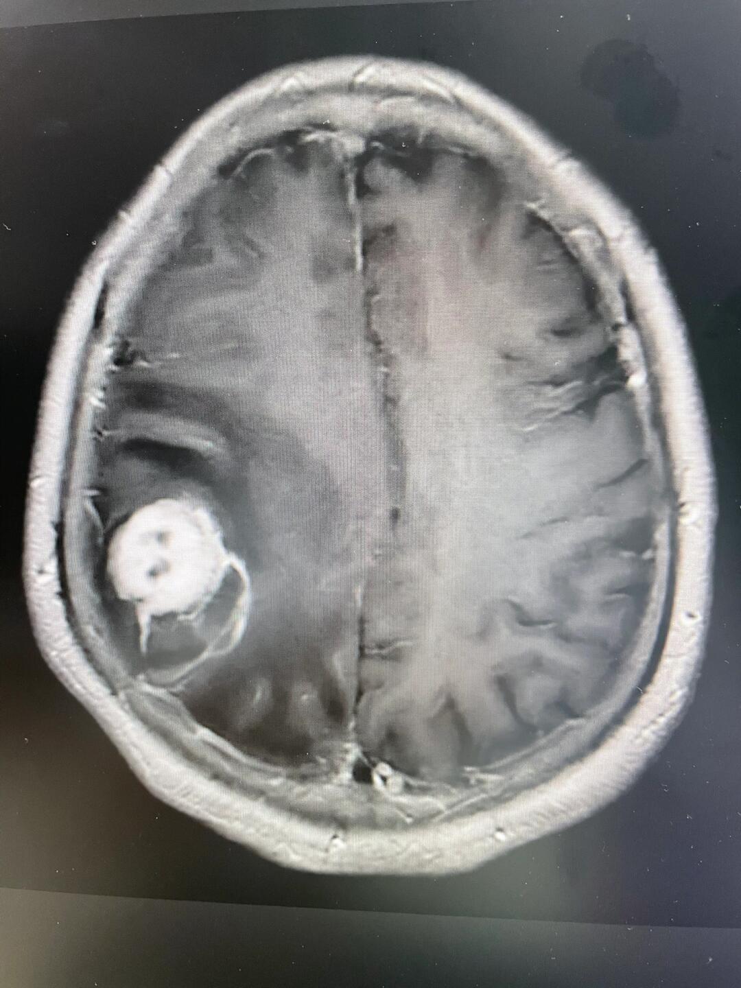 又一例肺癌脑转移癌