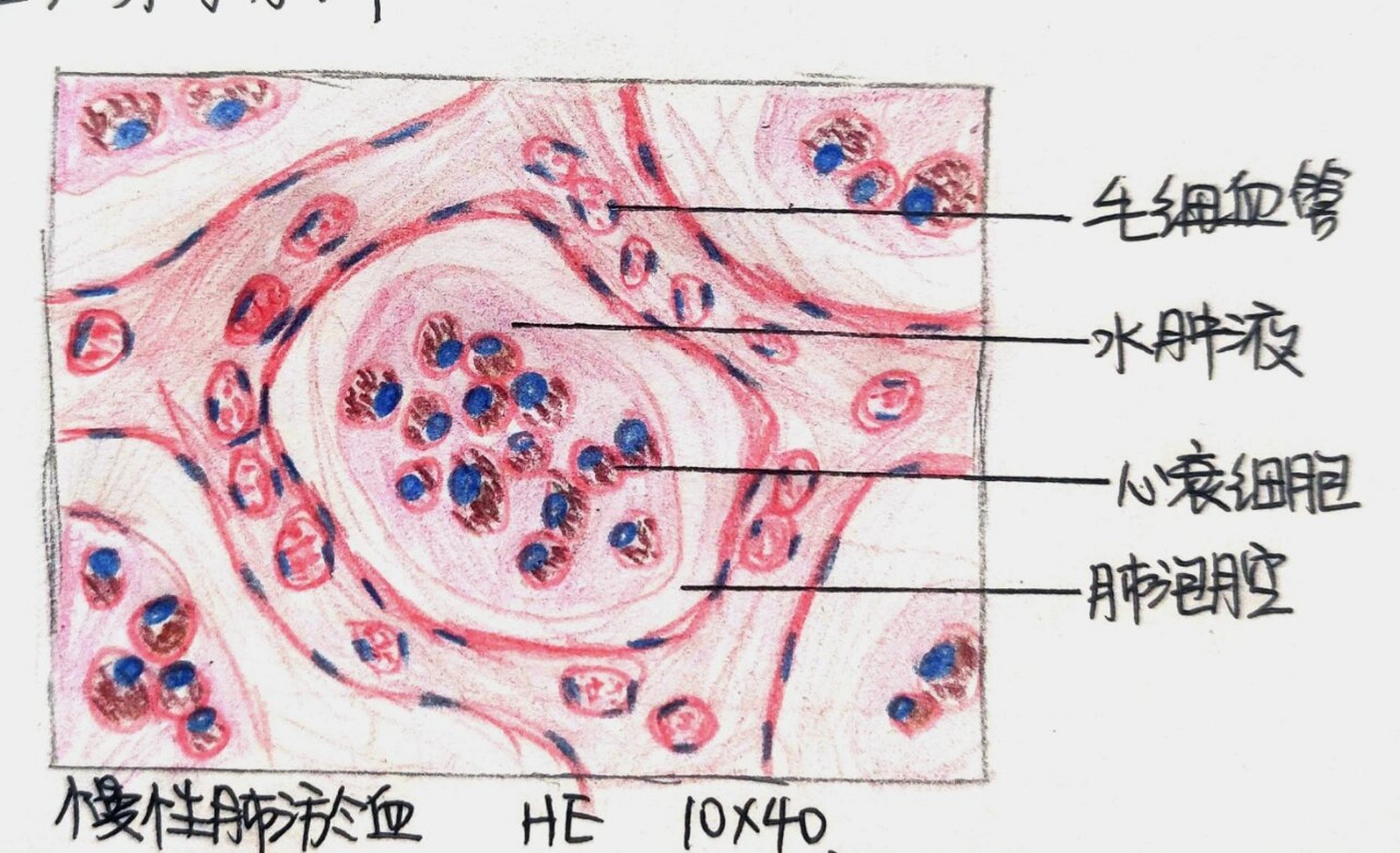 病理满分实验报告-慢性肺淤血 局部血液循环障碍 红蓝铅笔手绘 重点