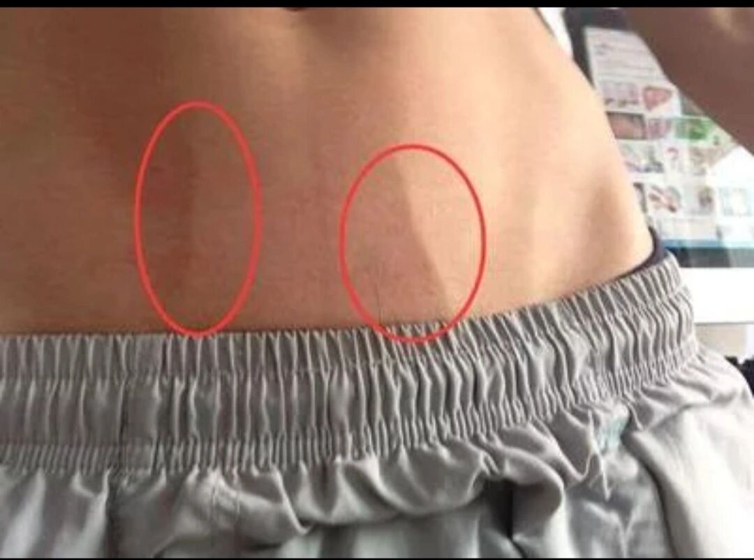 腹部有青筋 ■ 腹部可见明显凸起的青筋是肝硬化的表现.