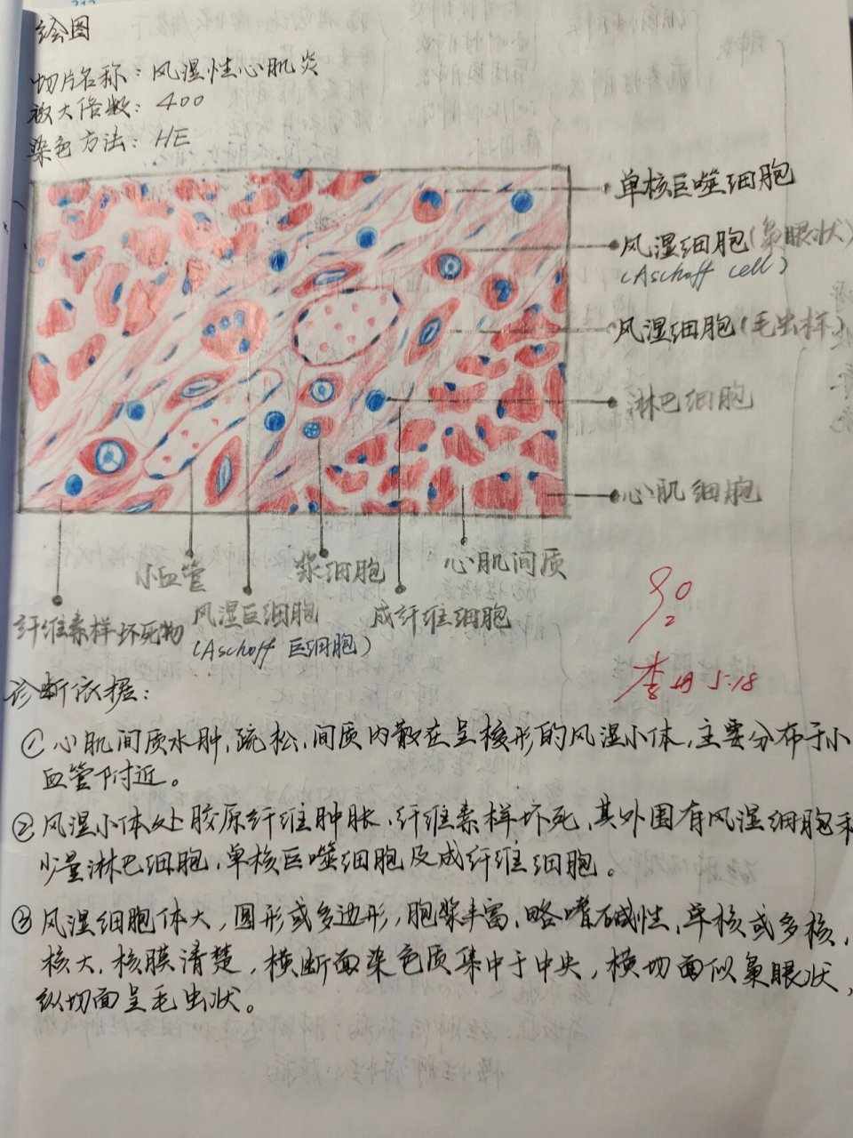 病理报告红蓝铅笔绘图 记录一下病理绘图  后续会加更 图一 肉芽组织