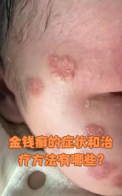 金钱癣的症状和治疗方法有哪些?
