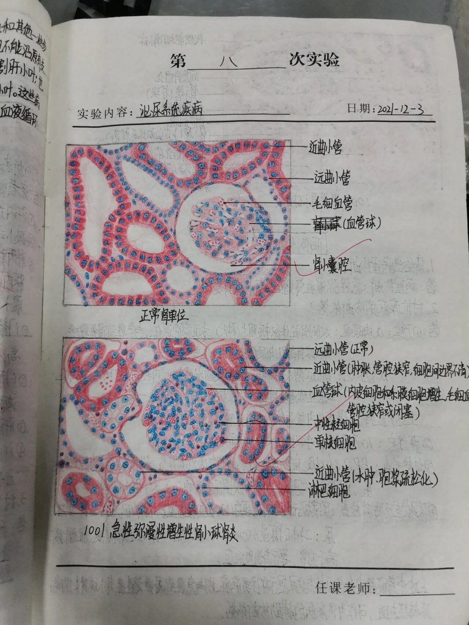 肾结核手绘图图片