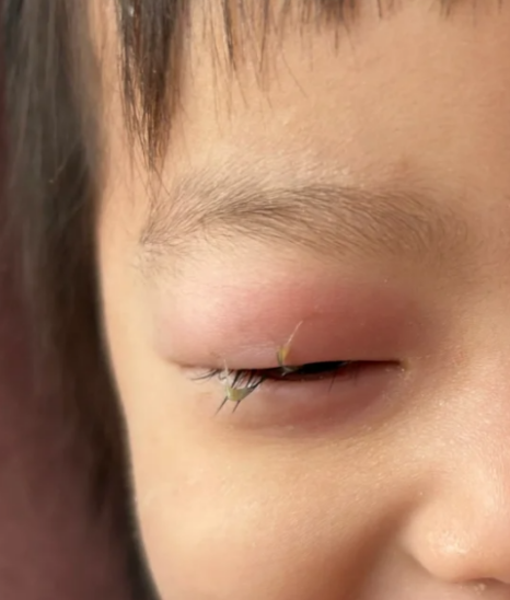 如果宝宝得了结膜炎,通常是因为感冒时鼻腔发炎,病菌通过鼻泪管感染