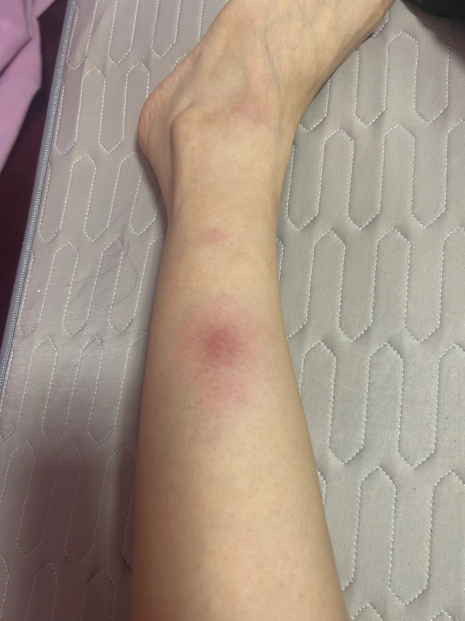 呜呜呜 有没有姐妹知道这是结节性红斑吗 前几天发烧,睡了一个晚上