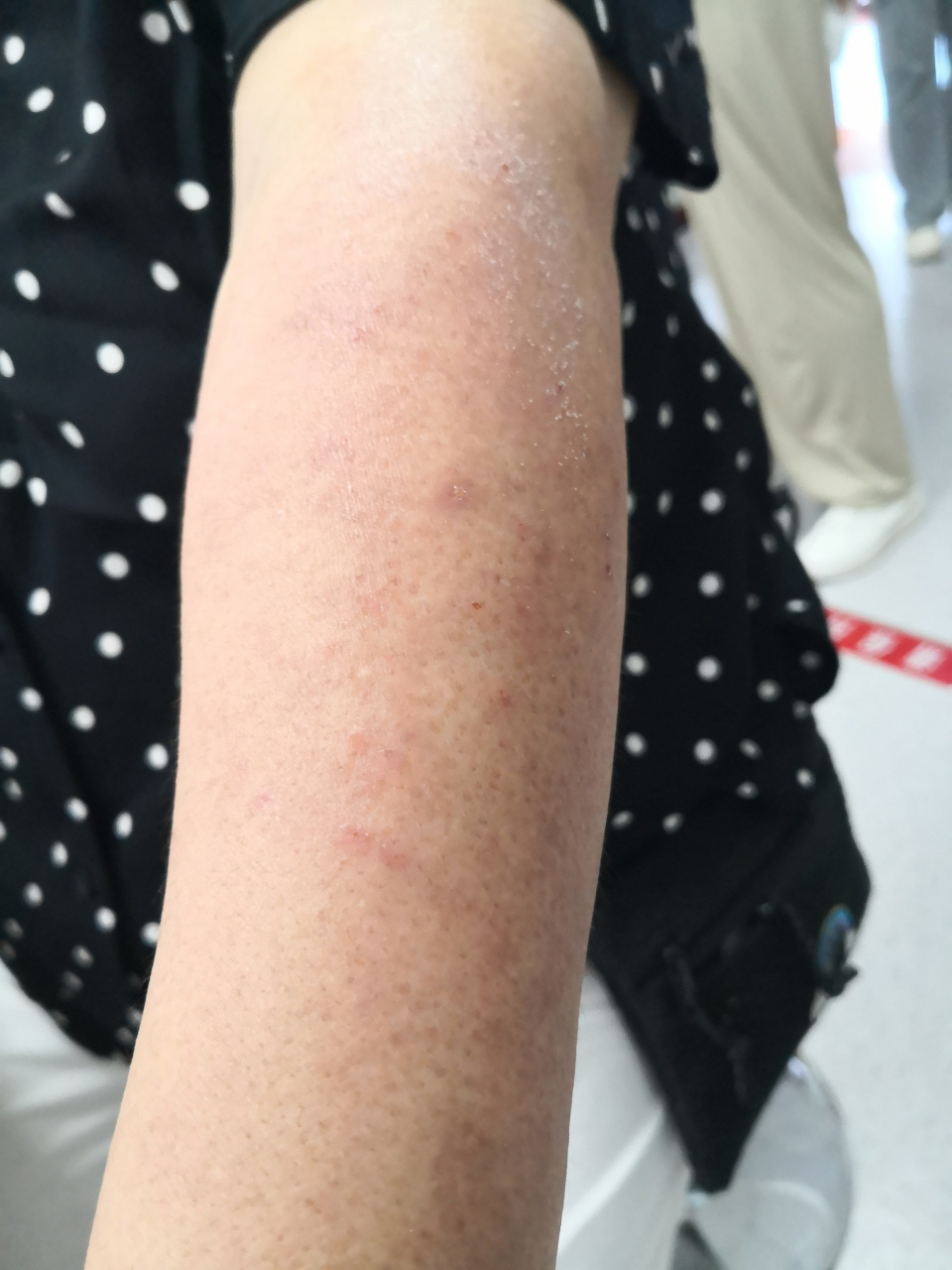 解决皮肤问题专注皮肤美容##紫外线过敏