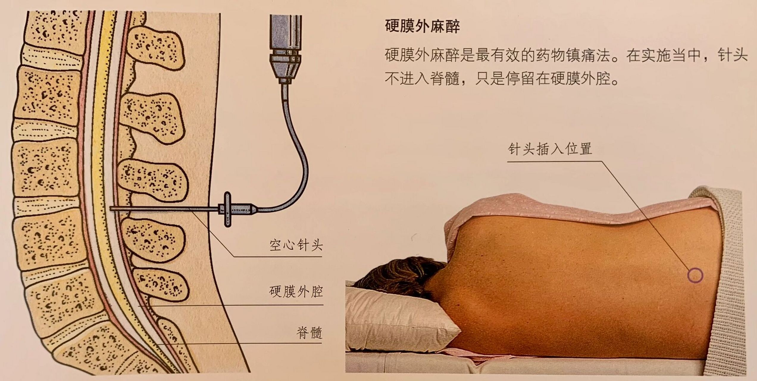 无痛分娩的利与弊(上) 很多姐妹恐惧顺产分娩中宫缩的疼痛,所以会选择