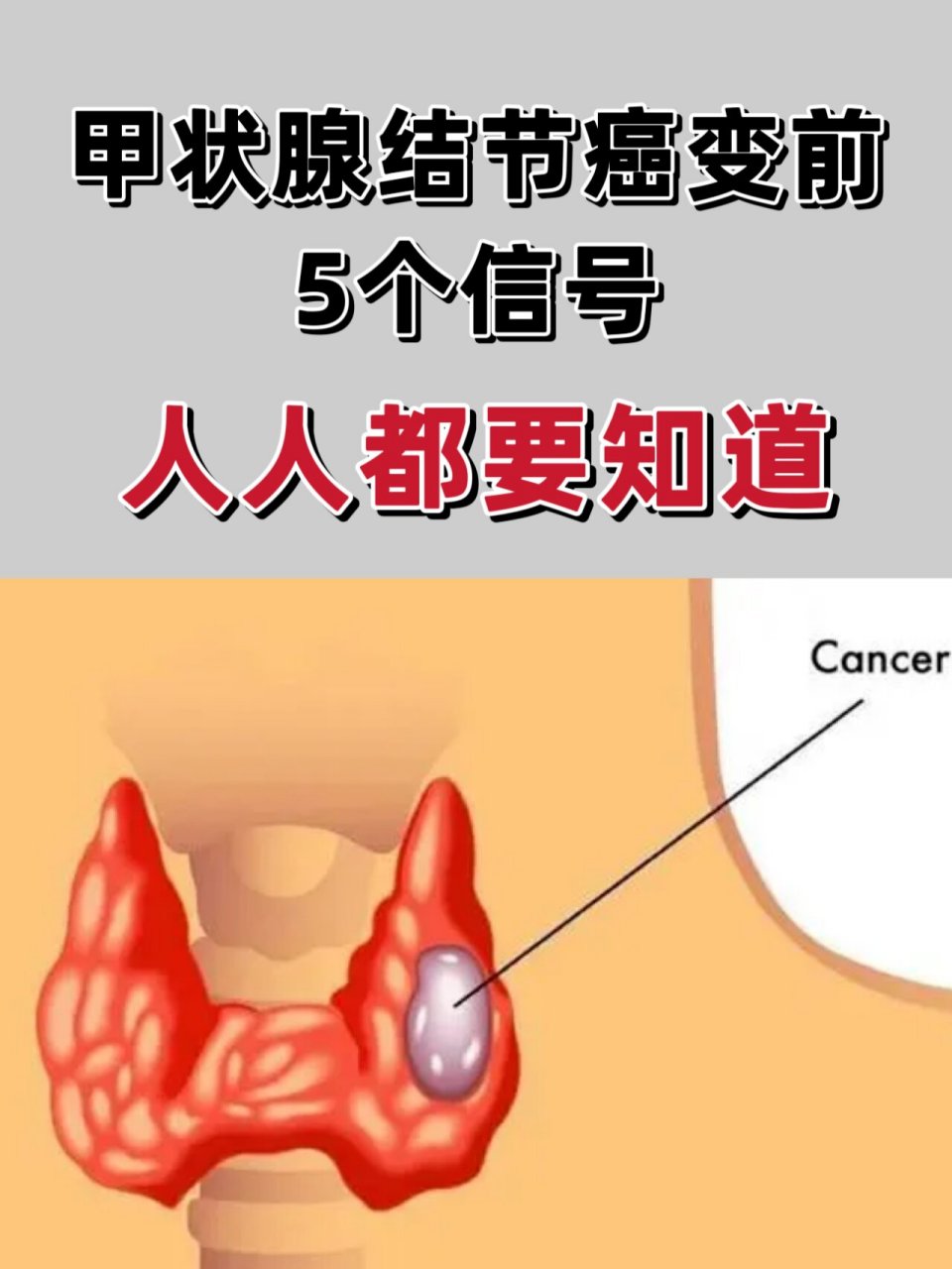 甲状腺结节恶变信号图片