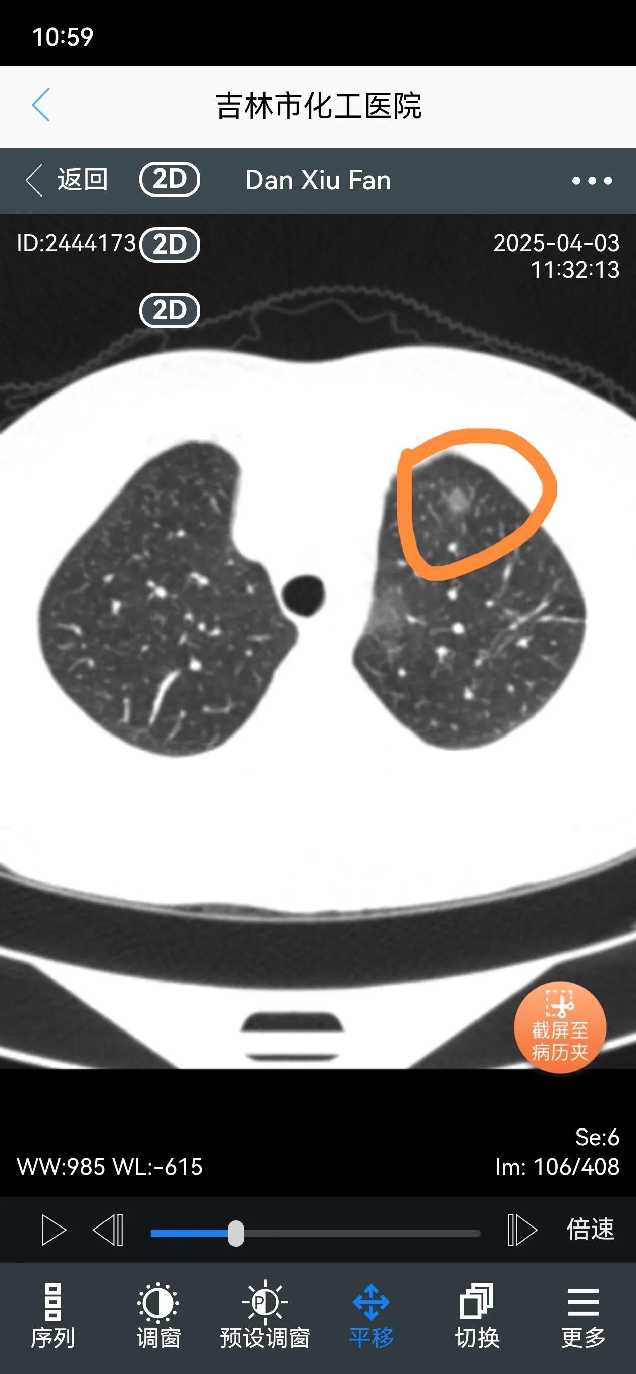 肺结节是肺部影像中的小阴影,多数为良性