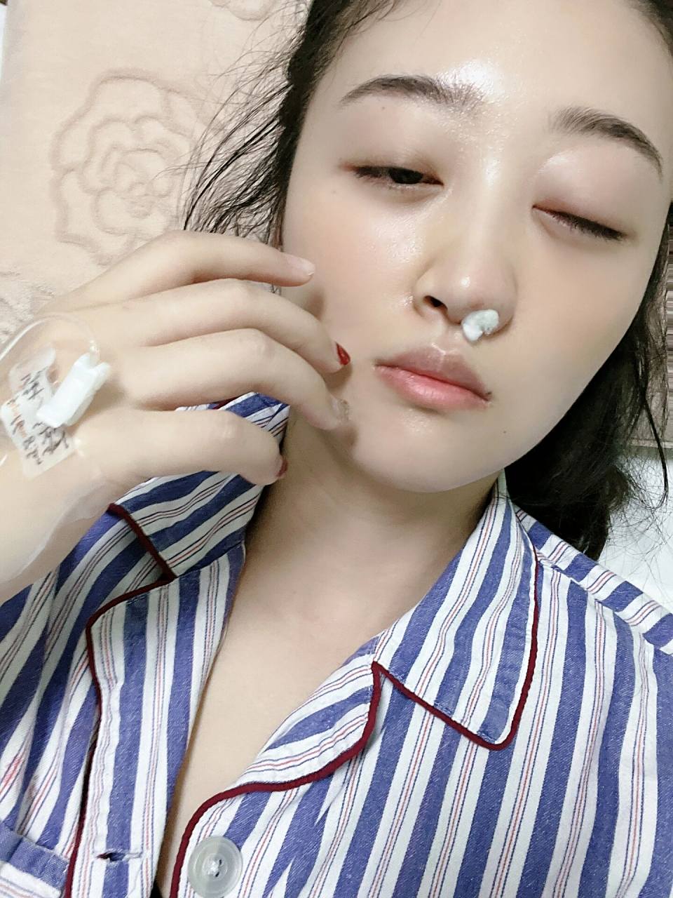 西安交大二附院真菌性鼻窦炎手术(一) 说起我这个上颌窦炎真的可以算