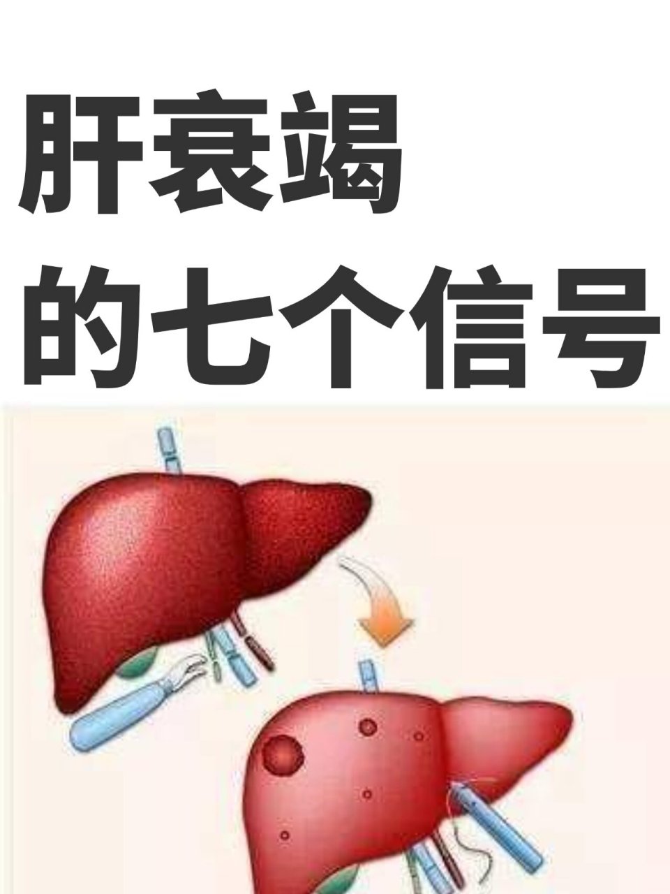 肝衰竭的七个信号 01 关节疼痛 肝功能衰竭的另一个常见症状就是关节