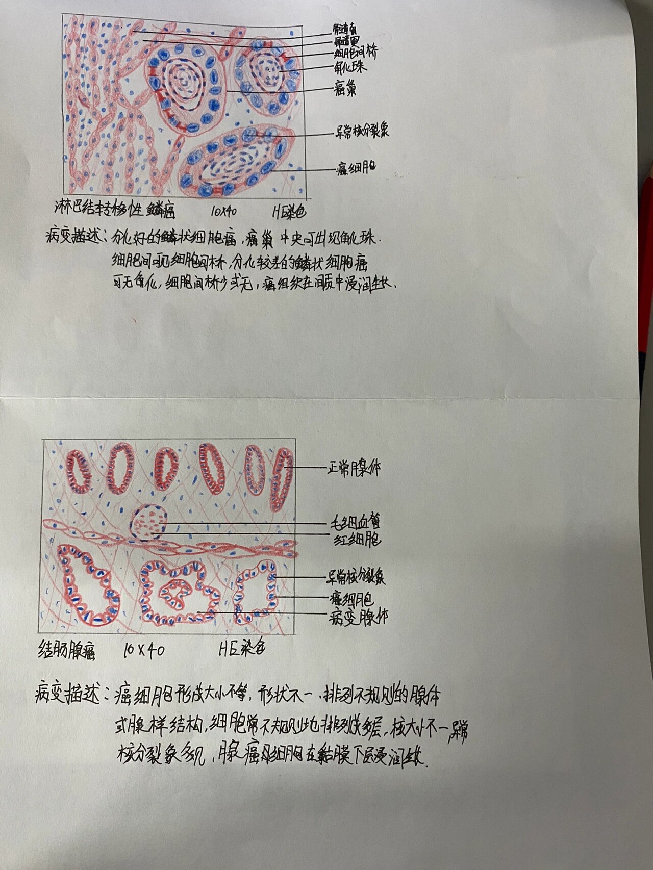 肾凝固性坏死手绘图图片