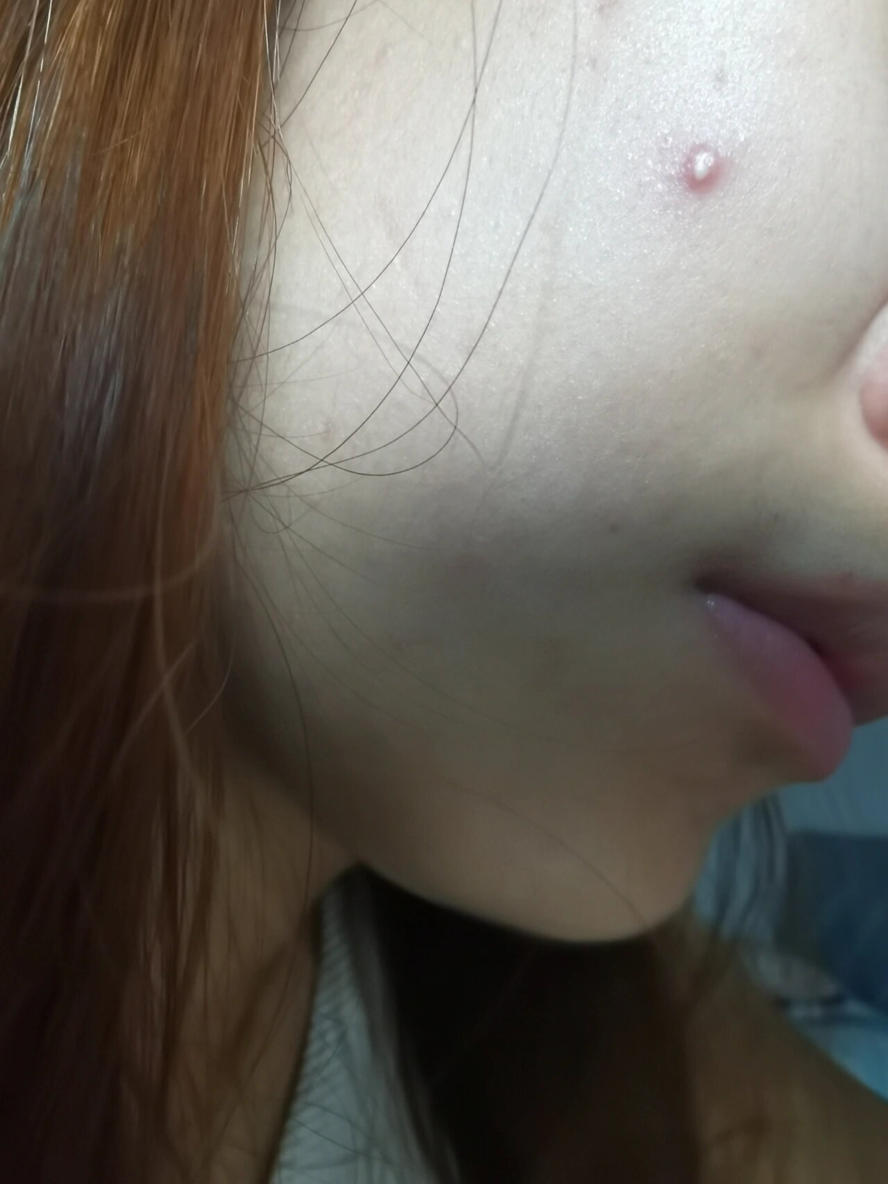 家人们,这是什么痘痘啊,又红有点肿,还冒白头