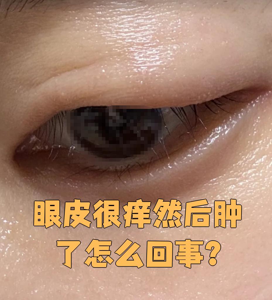 眼皮为什么会肿