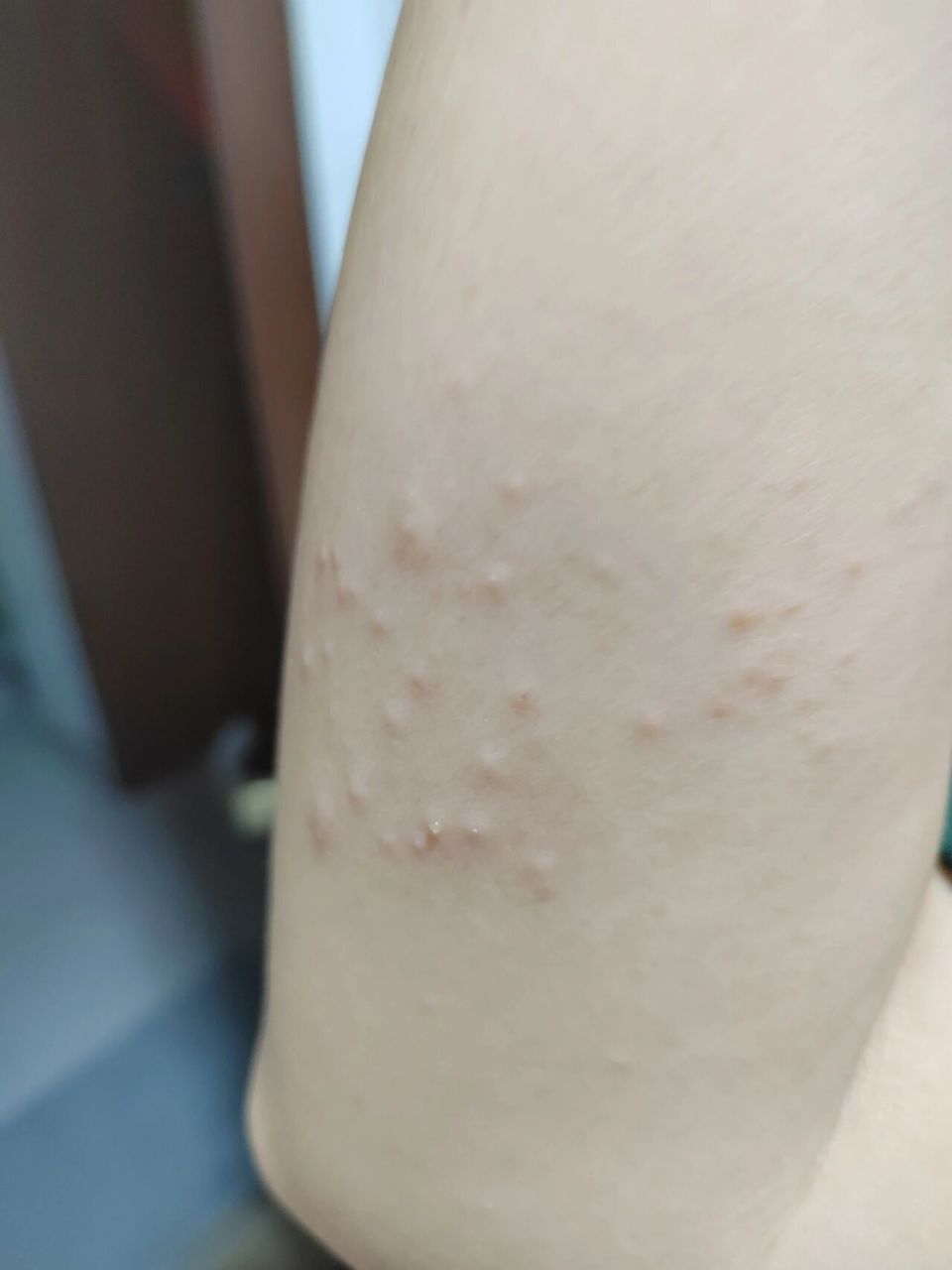 山药皮过敏成这样,是不是太夸张了 前几天买了山药回来煲汤,特地带了