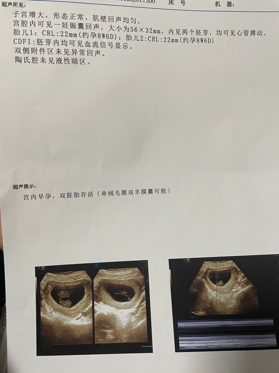 早孕双胎彩超报告图片图片