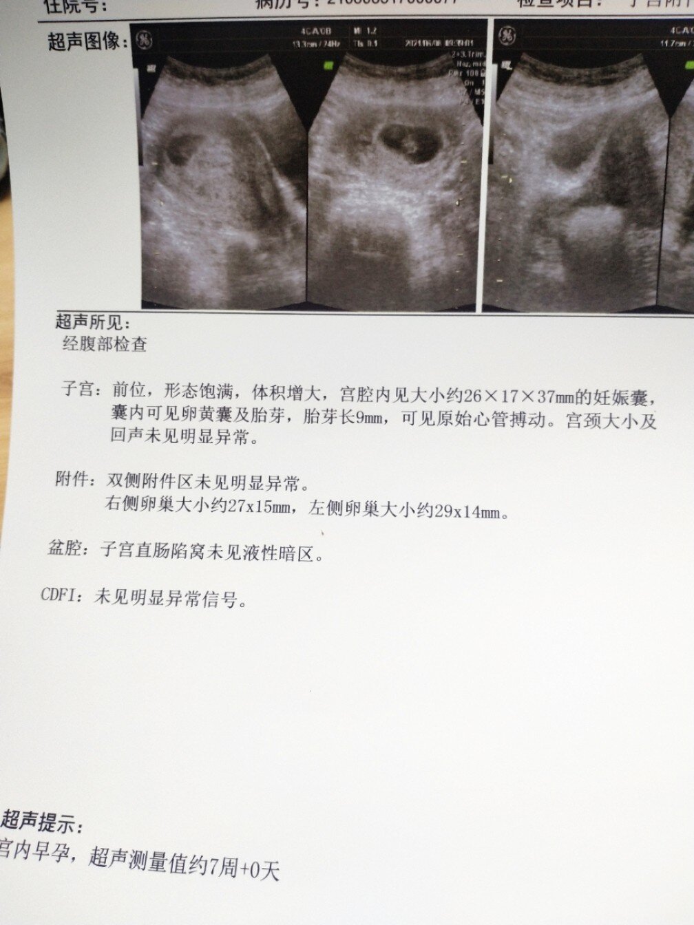 孕七周,有胎心胎芽啦!