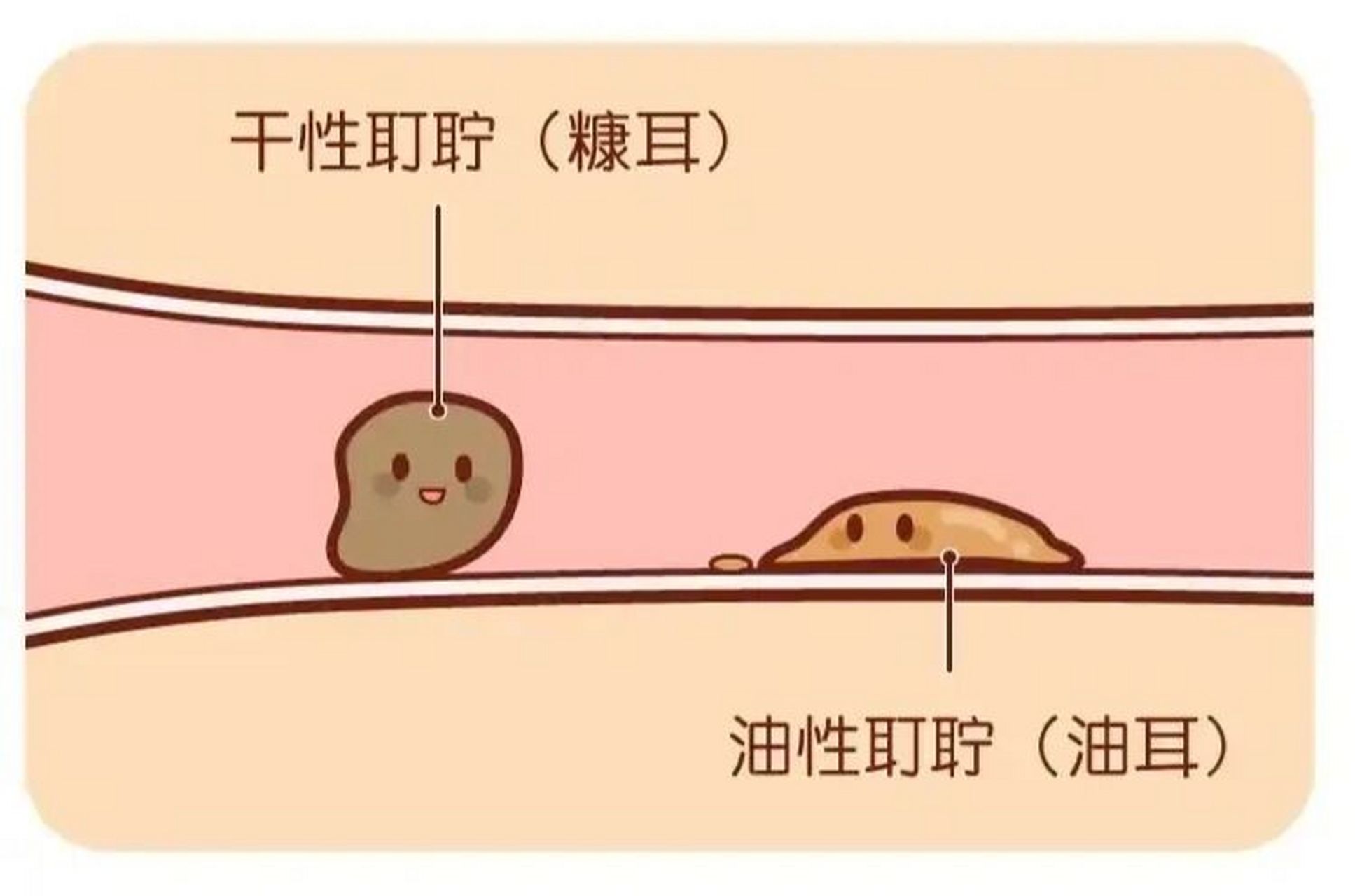 耵聍是干是湿是由16号染色体上的一对等位基因控制的,干耵聍为隐性.