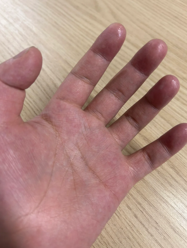 手汗症的特点是手掌在没有明显原因(比如高温或紧张)的情况下大量出汗