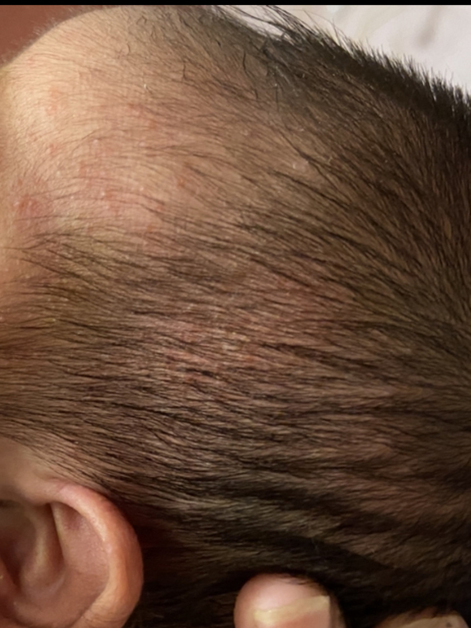 新生儿头垢 大概出生两周左右,头皮上开始起疹子,一片一片的红色疹子