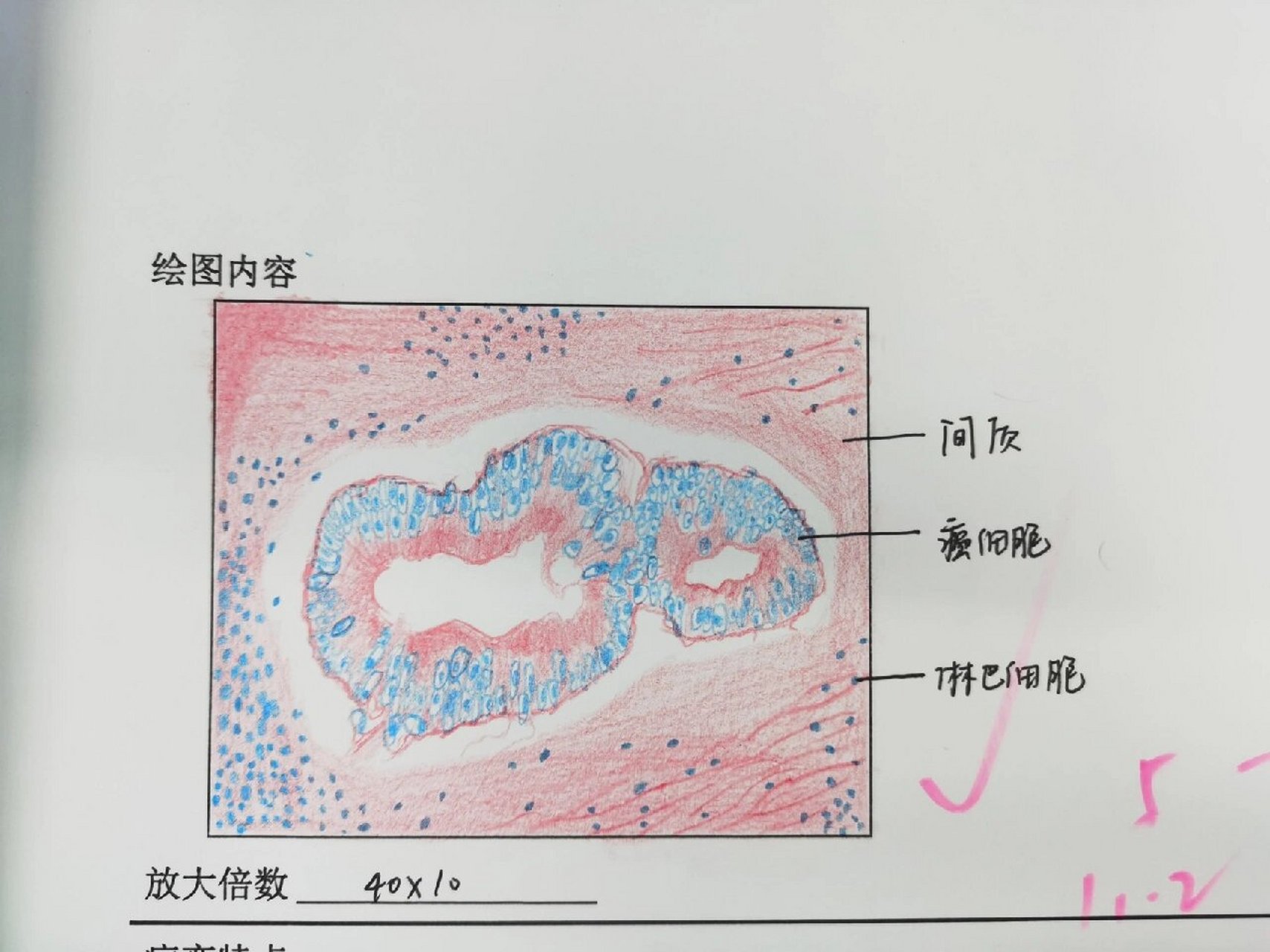 鼻息肉病理图片手绘图片