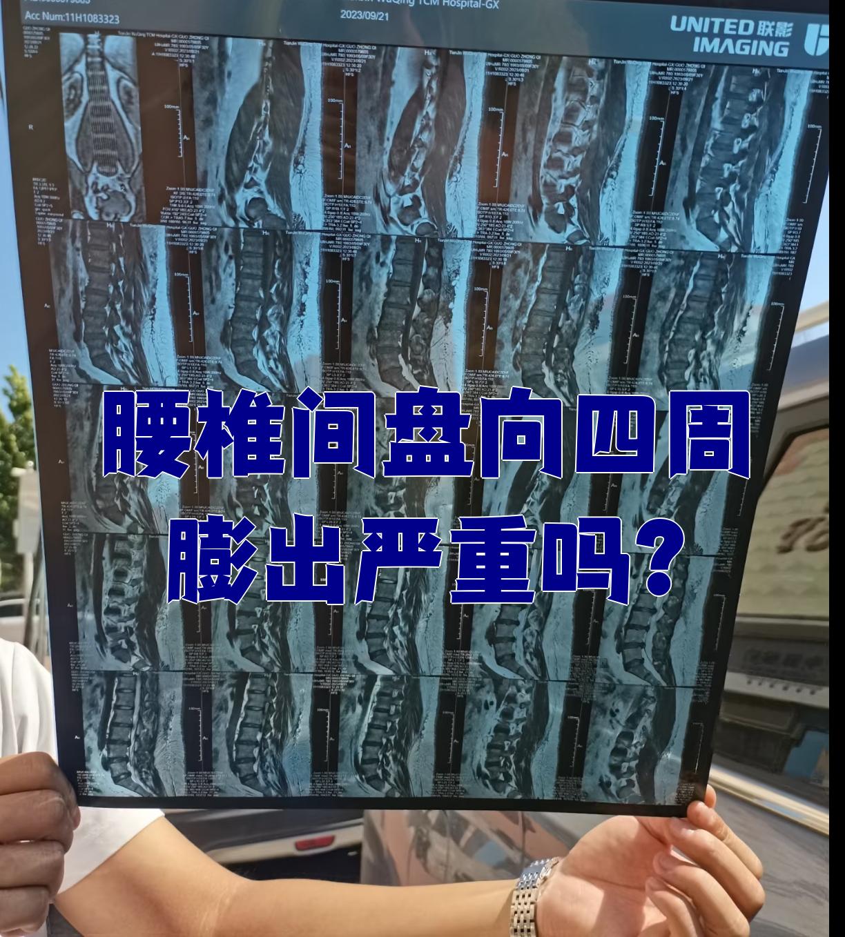 腰椎间盘向四周膨出,是腰椎间盘突出症的一种表现