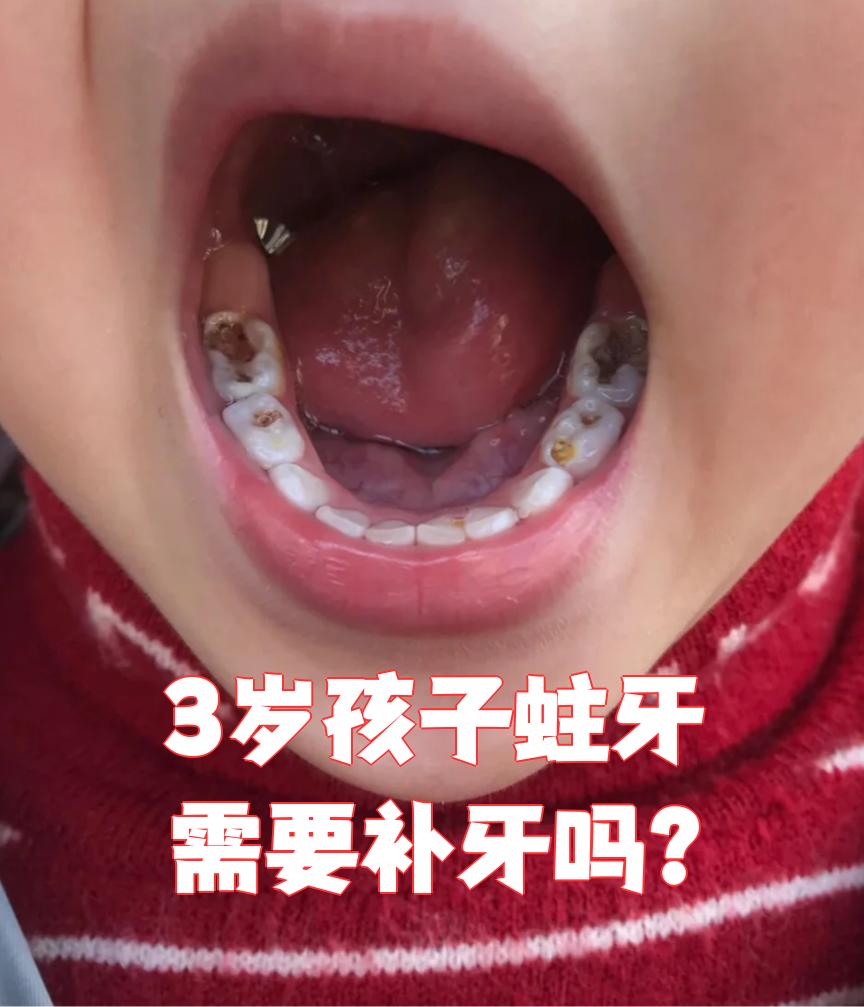 补牙能有效阻止龋齿发展