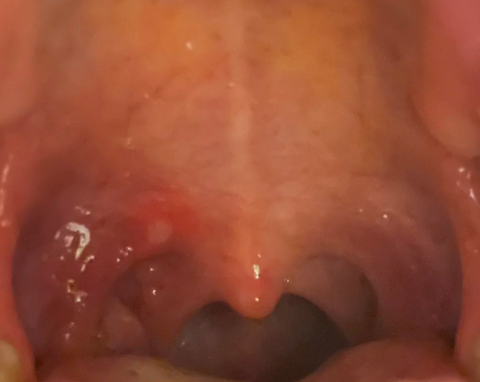 上颚出现凸起的硬块并且按压疼痛,常见原因包括骨突,口腔溃疡和腭腺