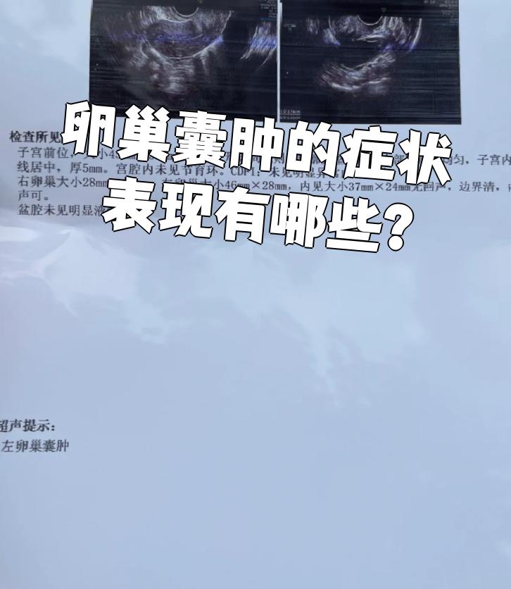 卵巢囊肿的症状表现主要和囊肿大小有关