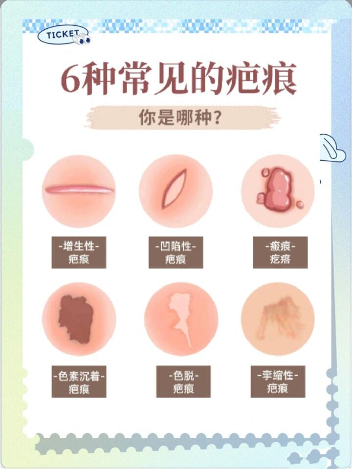 疤痕体质的人在人群中比例极小,其表现为伤愈合后,表面疤痕呈持续性