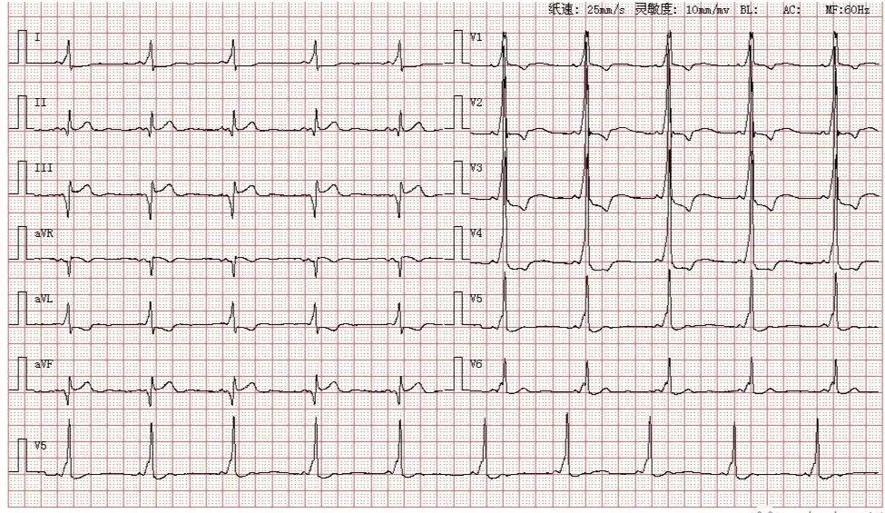 心电图图库丨心室预激系列
