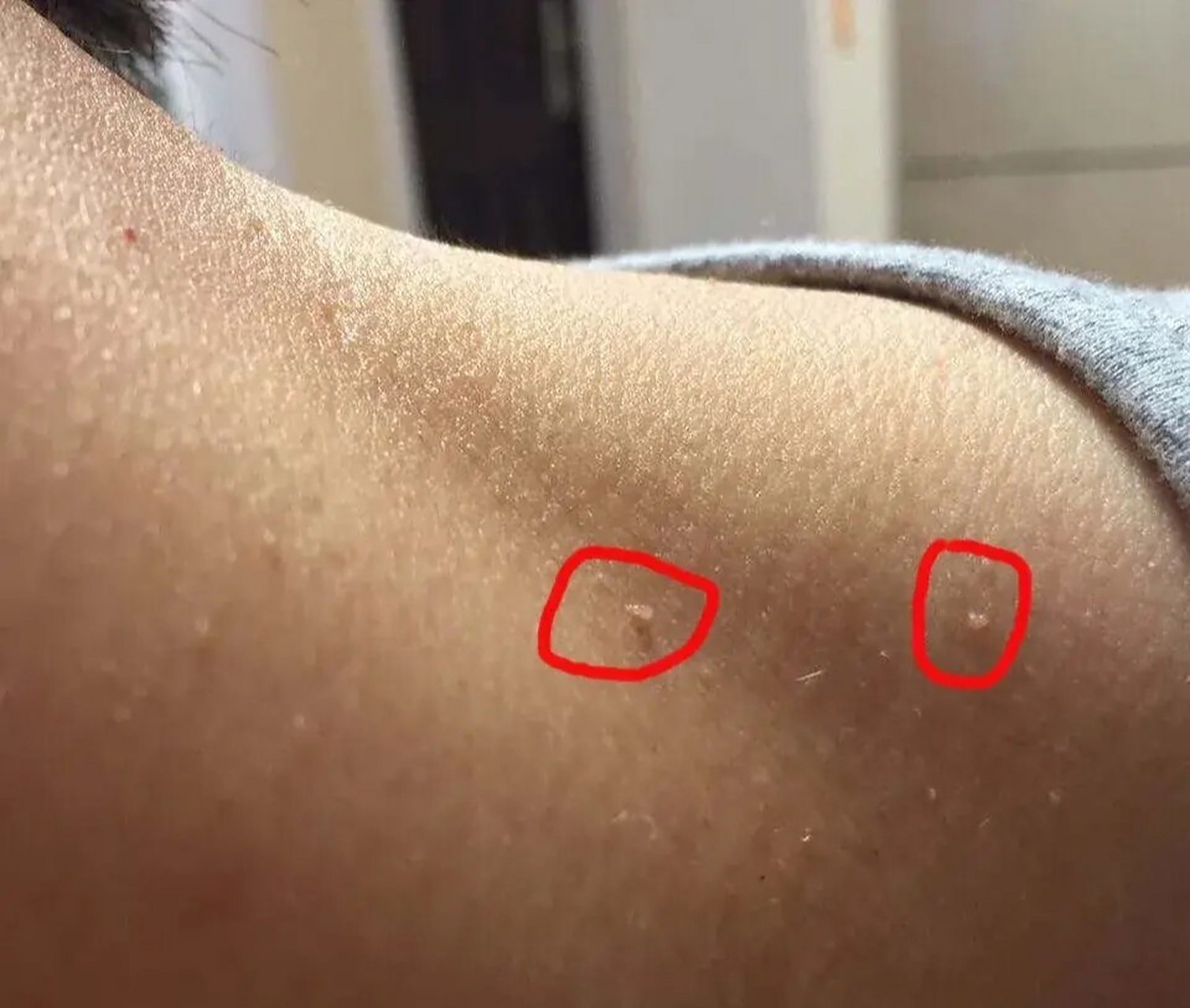 软纤维瘤(皮赘)如何处理 很多人都有像以下图片这样的情况,就是脖子