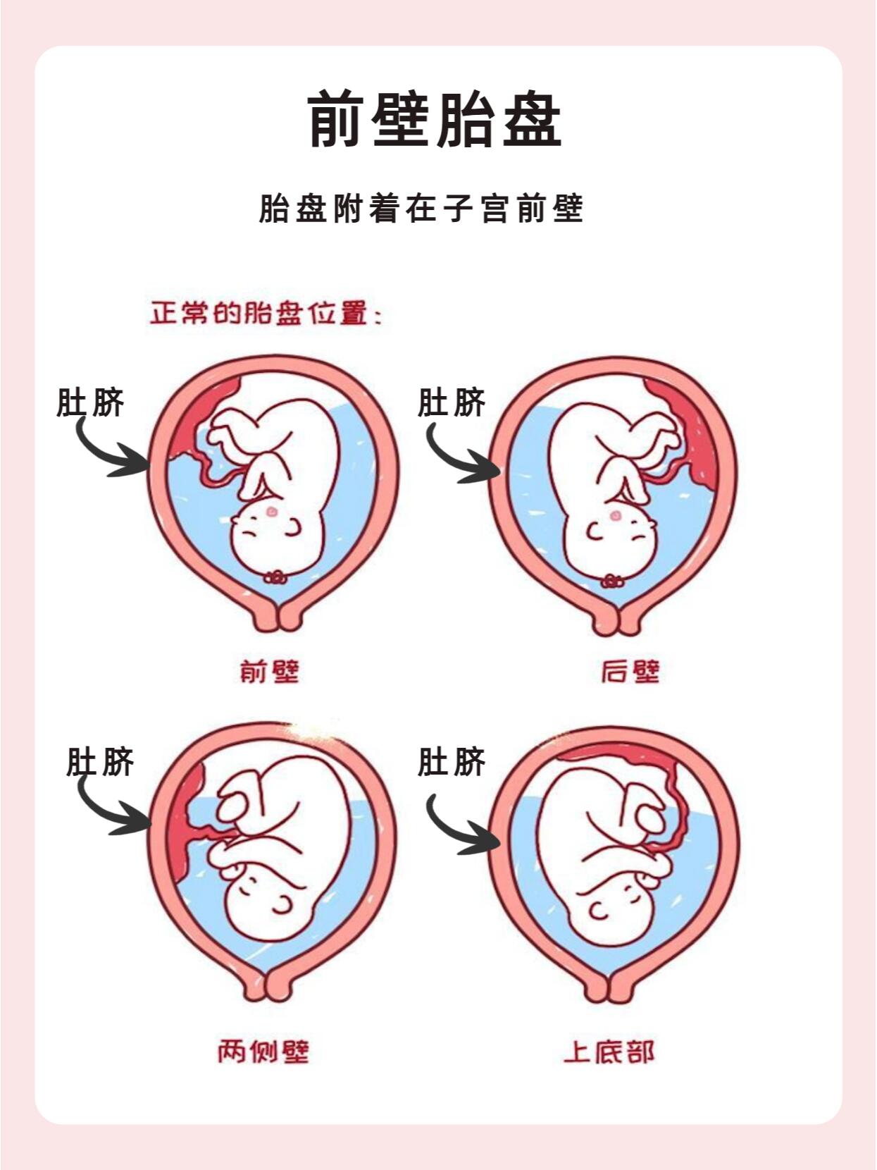 前置胎盘图解图片