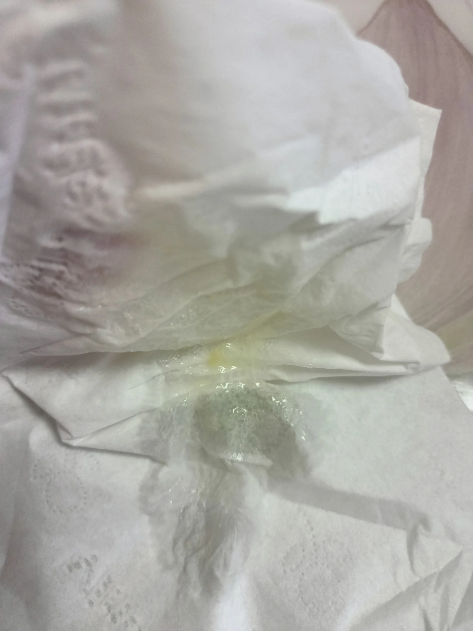 昨晚吃阿莫西林克拉维酸钾,今早情况记录 今早洗鼻子,吐出来黄痰,昨天