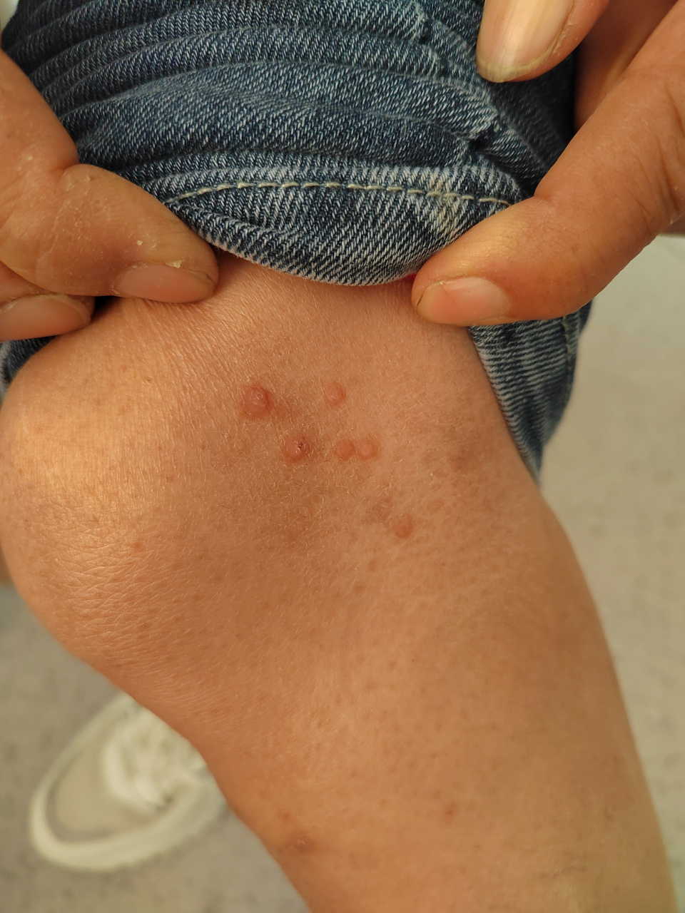 躯干四肢多发结节性痒疹症状.考虑诊断特应性皮炎结节型.