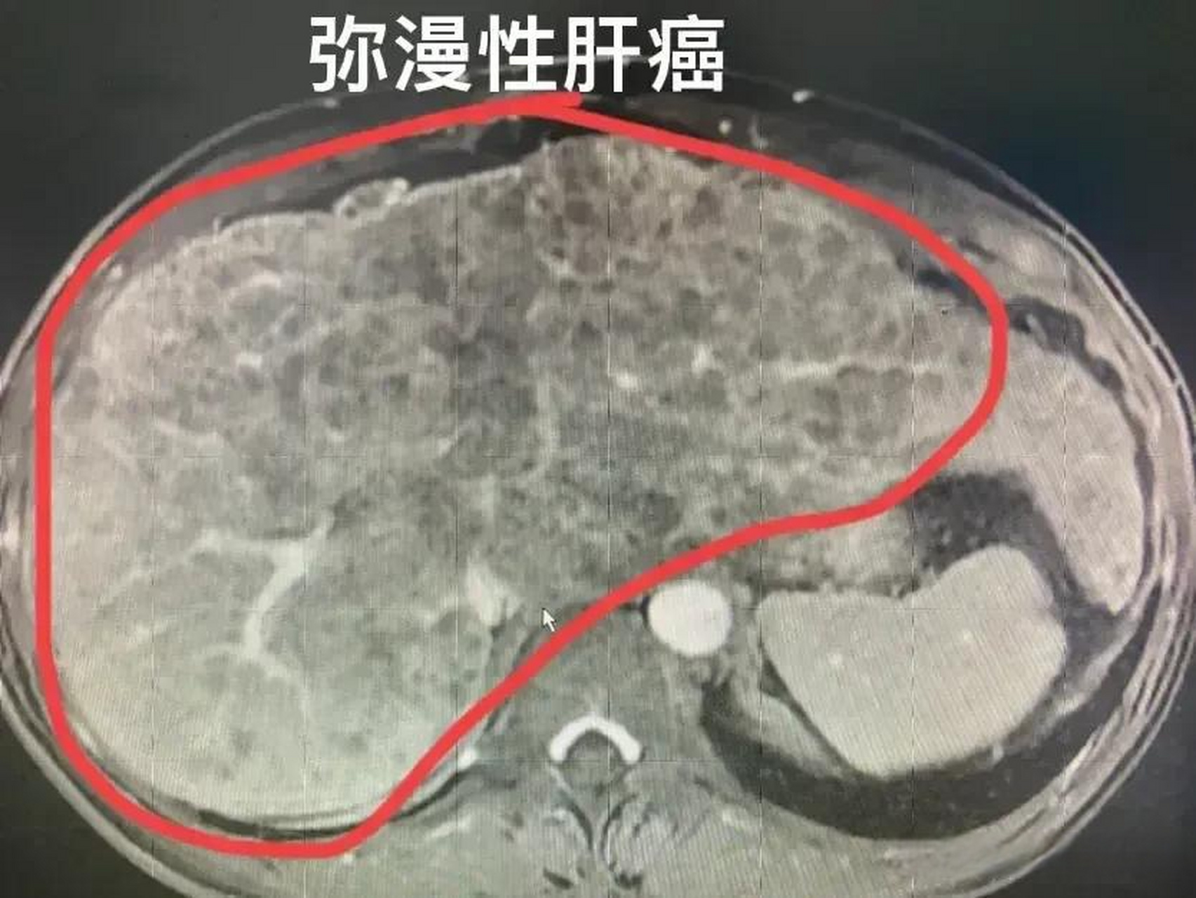 曾经碰到一个肝癌晚期的病人,60岁,肝内弥漫性肝癌伴有门静脉癌栓 一