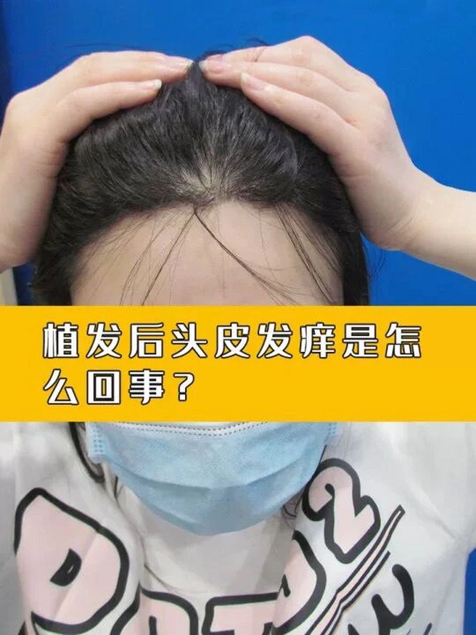 植发头皮消毒(植发手术后用什么头皮营养液)