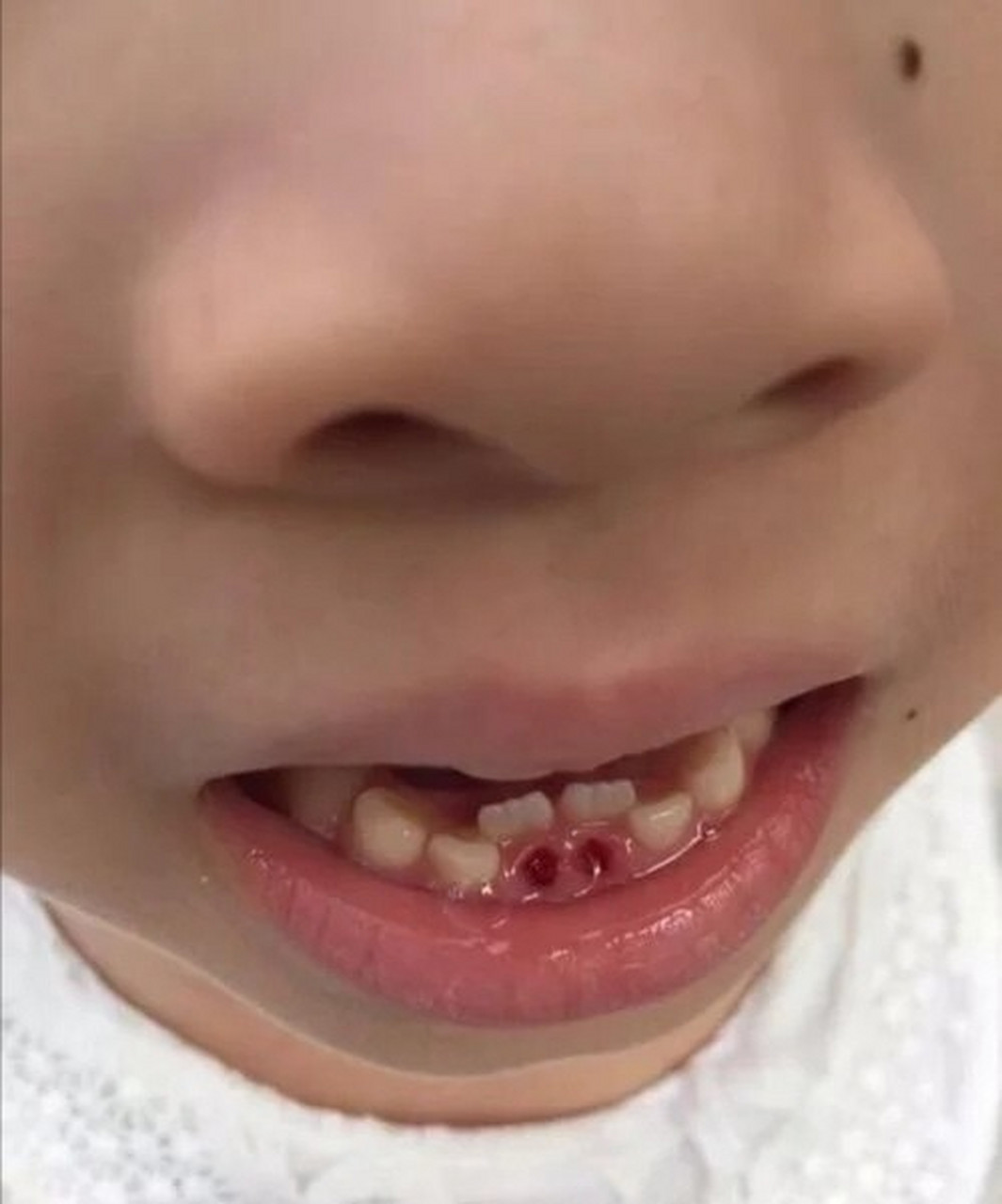 宝宝已经发生乳牙滞留 宝宝已经发生乳牙滞留,妈妈们知道怎么办吗?