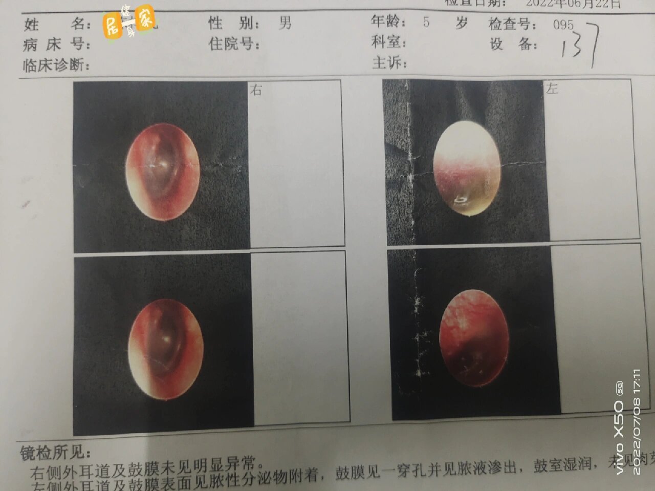 小孩耳膜破了图片图片