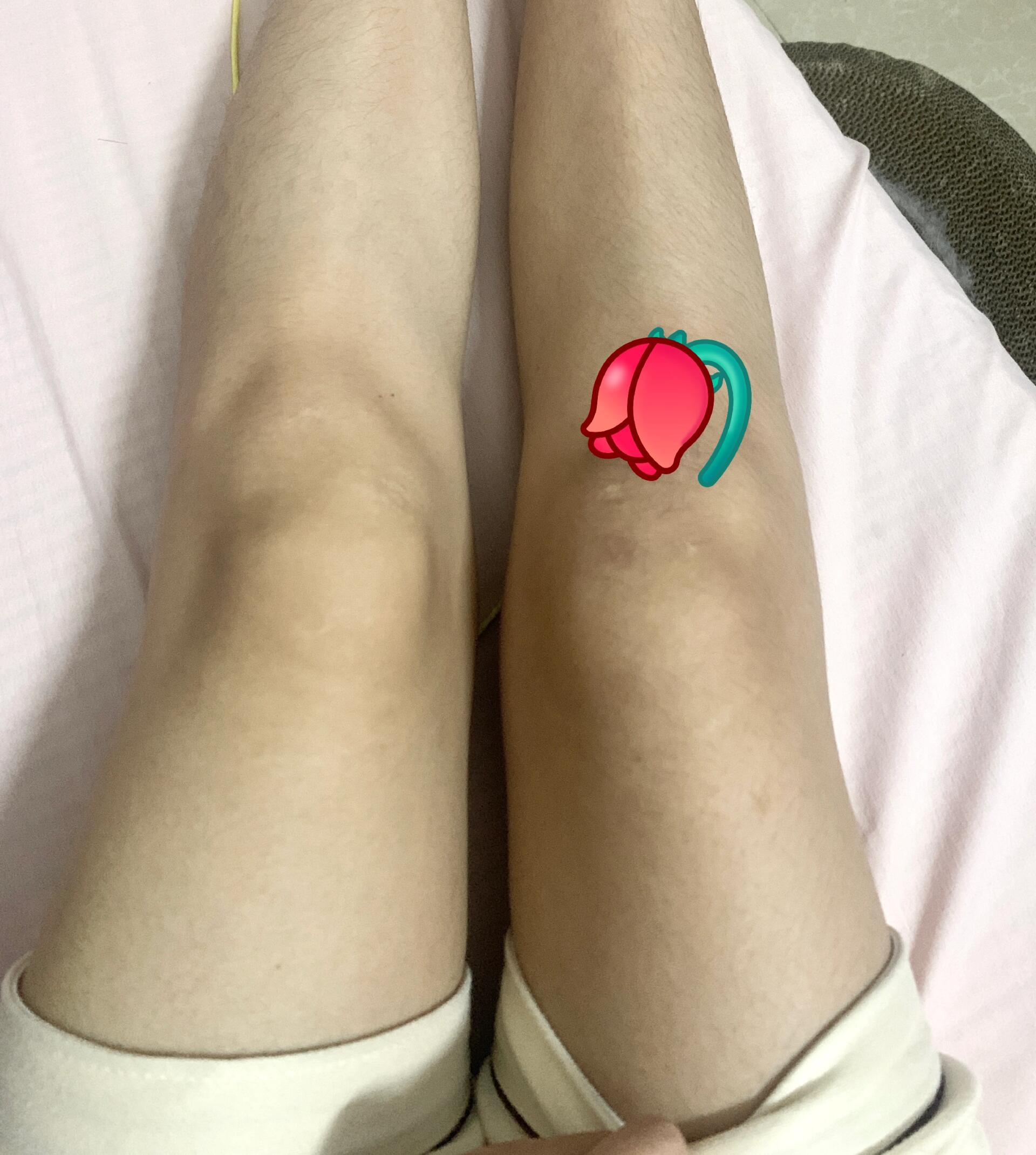 韧带损伤四个月了还没好?