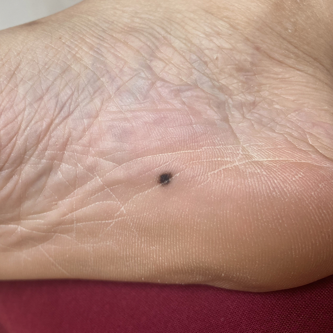 脚底痣 这颗痣五年前长的 我妈一直都在说去医院看看,然后平时也有点