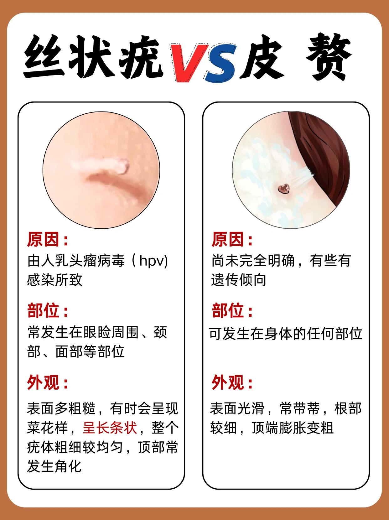 脖子上的小肉揪到底是丝状疣还是皮赘呢7171 发现很多宝子都分不