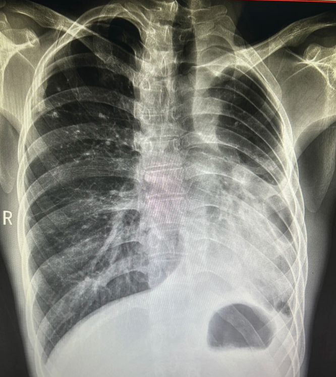 原发性肺结核在胸片上常表现为肺中下叶的小片状浸润病灶,同时可能有
