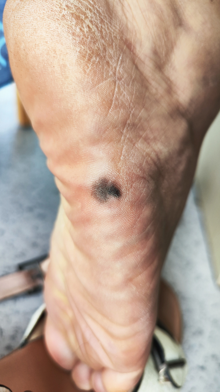 解决皮肤问题专注皮肤美容##色素痣##黑色素瘤