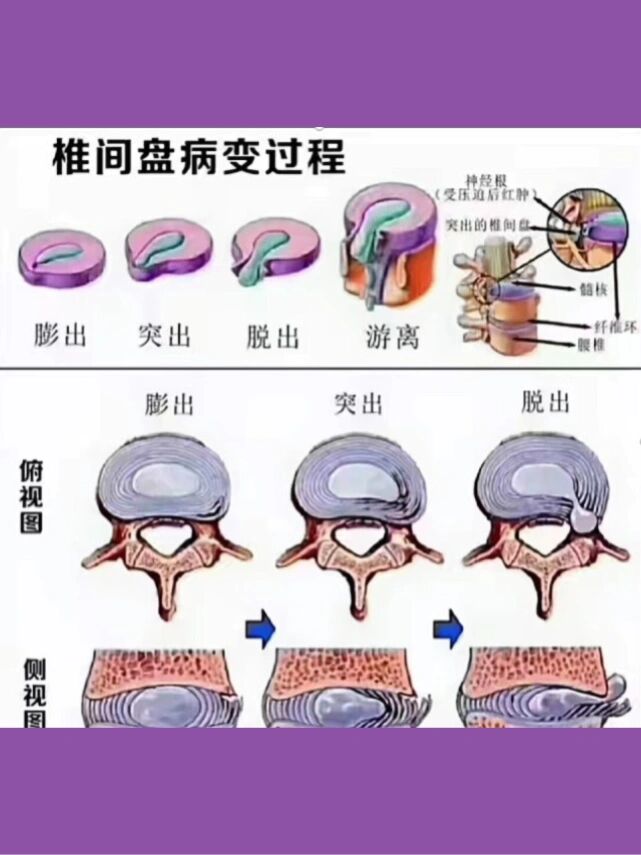 腰椎间盘膨出,突出,脱出,三个有什么区别?